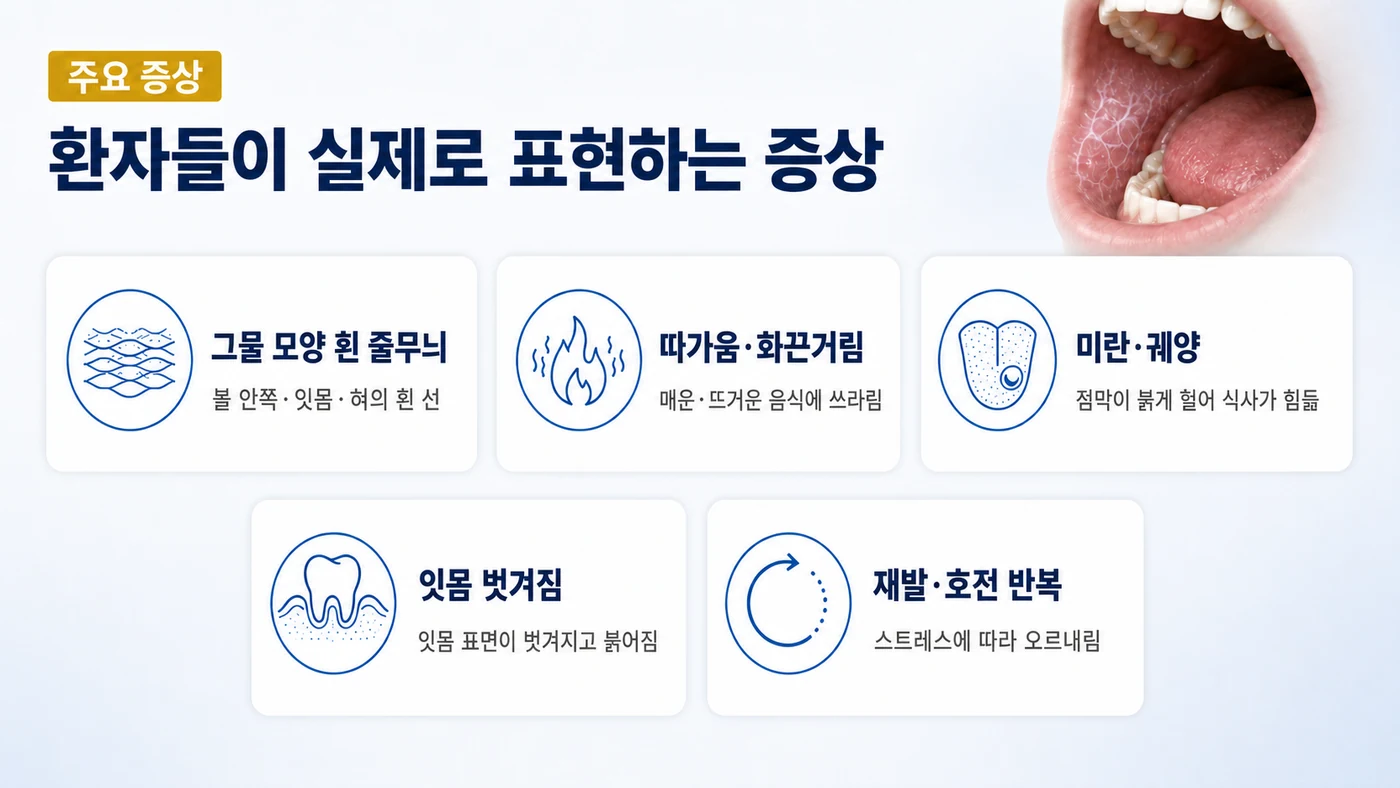 구강 편평태선의 주요 증상 — 그물 모양 흰 줄무늬, 따가움·화끈거림, 붉은 미란·궤양, 잇몸 벗겨짐, 재발·호전 반복