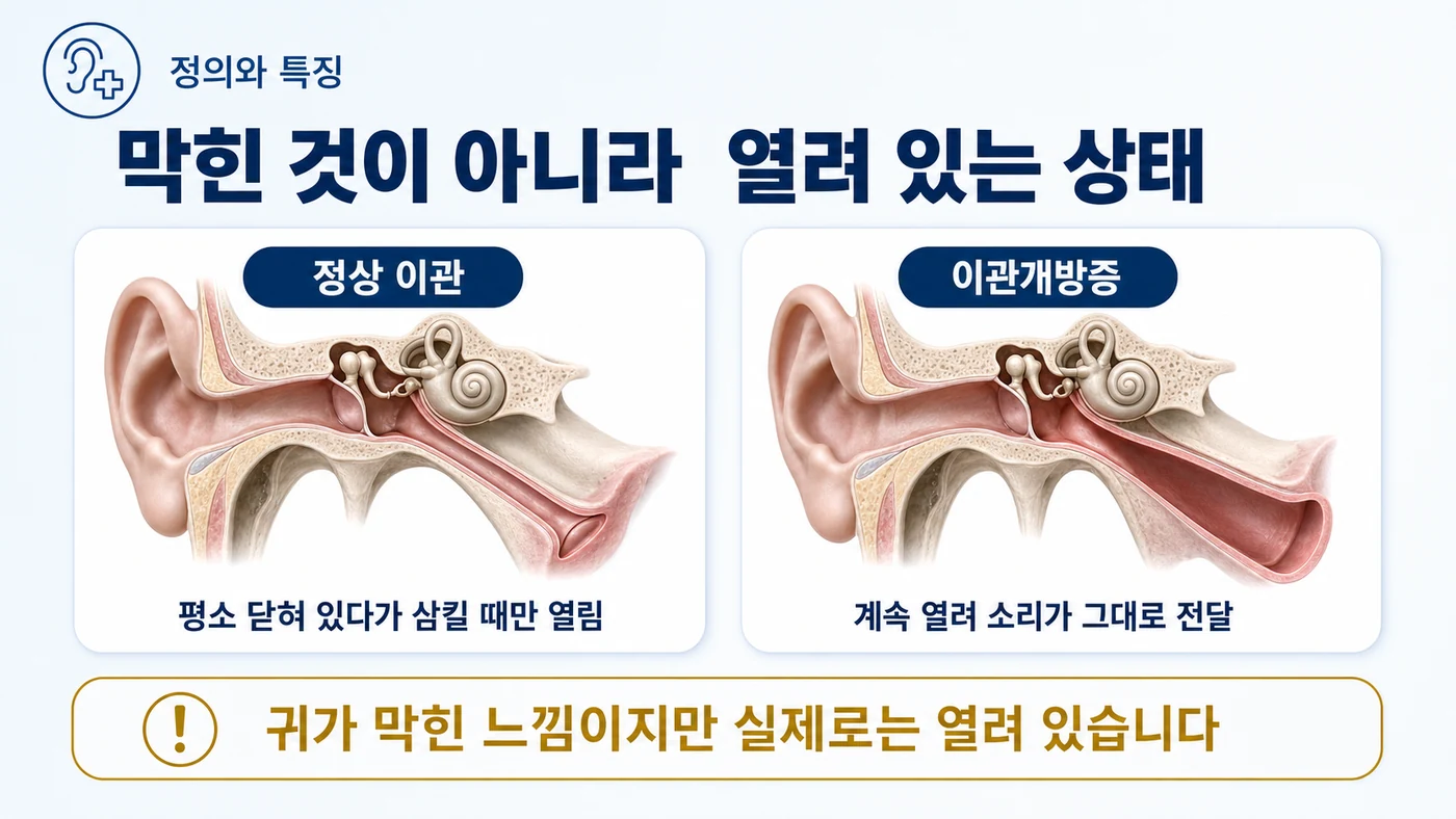 이관개방증이란 — 정상 이관은 평소 닫혀 있다가 삼킬 때만 열리지만, 이관개방증에서는 계속 열려 소리가 그대로 전달되어 귀가 막힌 느낌이 들지만 실제로는 열려 있는 상태