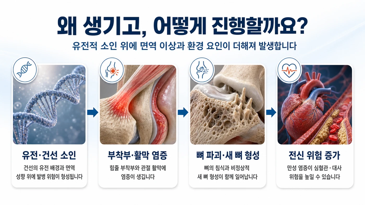 건선관절염의 발생과 진행 — 유전·건선 소인에서 부착부·활막 염증, 뼈 파괴와 새 뼈 형성, 심혈관·대사 등 전신 위험 증가로 이어지는 흐름