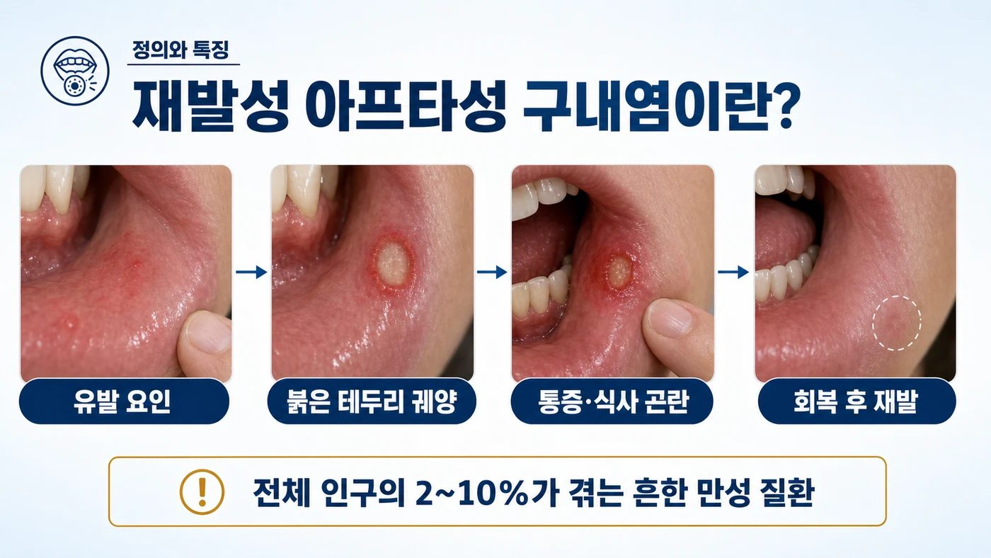 재발성 아프타성 구내염이란 — 유발 요인, 붉은 테두리 궤양, 통증·식사 곤란, 회복 후 재발로 이어지는 주기와 인구의 2~10%가 겪는 흔한 만성 질환