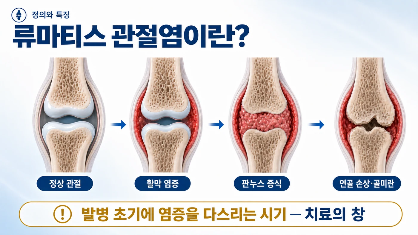 류마티스 관절염이란 — 정상 관절에서 활막 염증, 판누스 증식, 연골 손상과 골미란으로 진행되는 과정과 조기 치료의 창