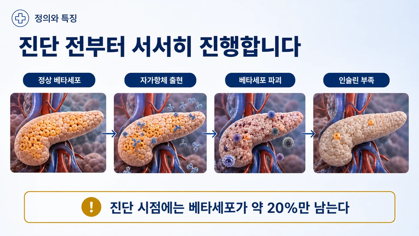 1형 당뇨병의 진행 — 정상 베타세포에서 자가항체 출현, 베타세포 파괴, 인슐린 부족으로 이어지며 진단 시점에는 베타세포가 약 20%만 남아 있음