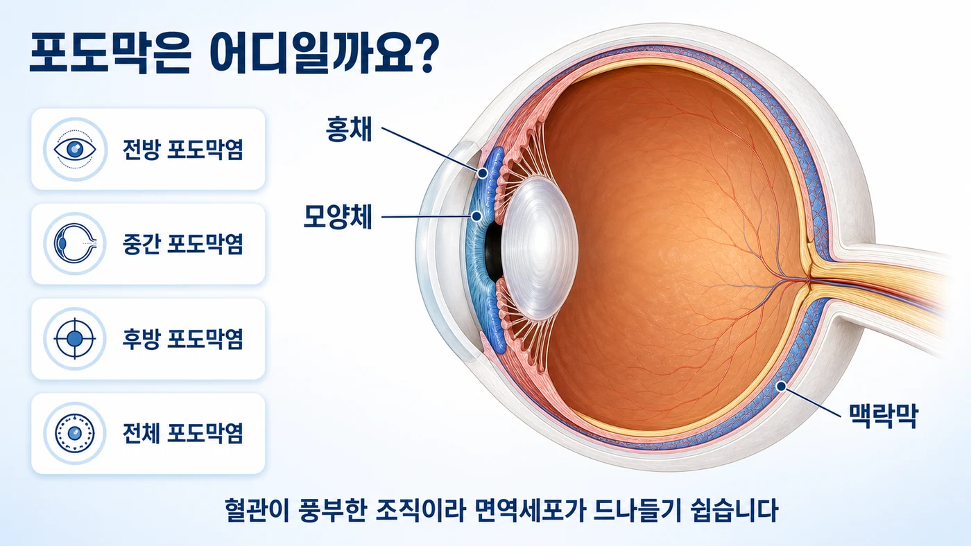 눈 단면도에서 포도막을 이루는 홍채·모양체·맥락막의 위치와 전방·중간·후방·전체 포도막염의 구분