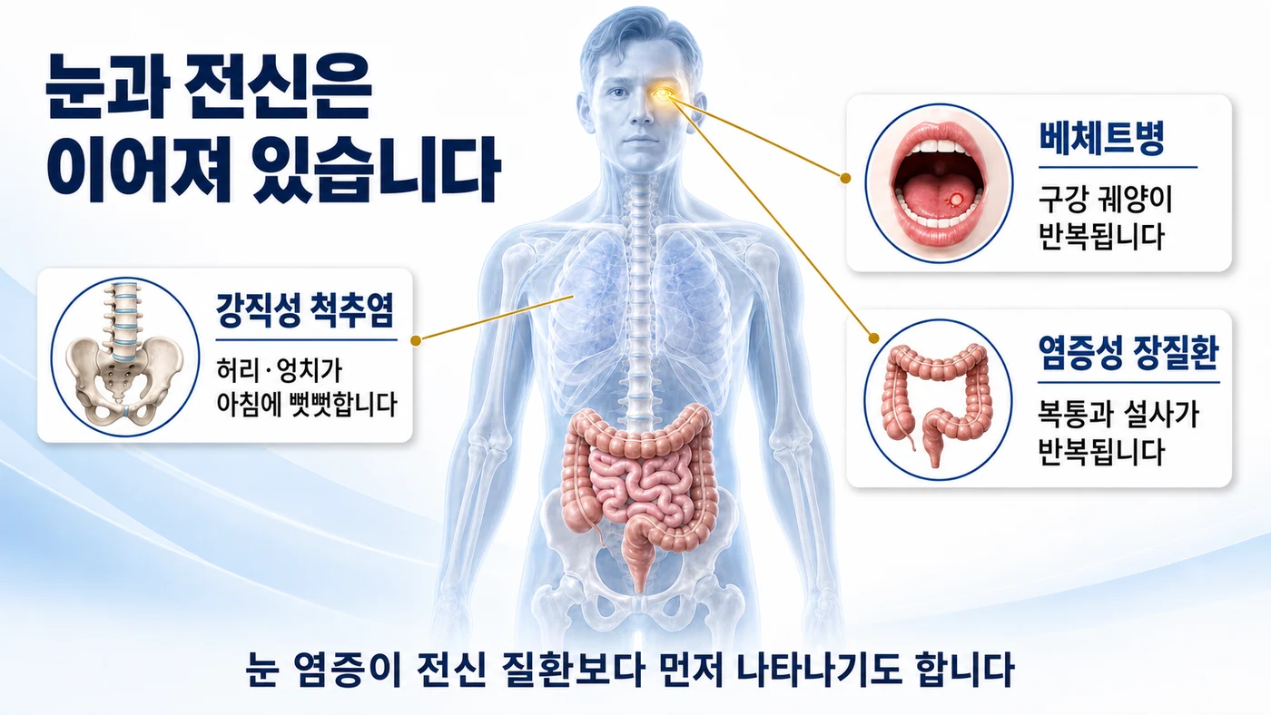 포도막염과 함께 나타날 수 있는 강직성 척추염, 베체트병, 염증성 장질환 등 전신 자가면역질환